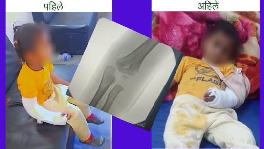 भाँचिएको हातमा नभएर अर्कै हातमा प्लाष्टर